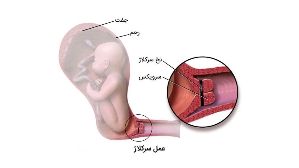 سرکلاژ
